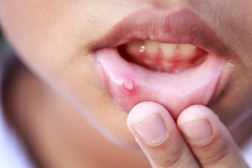 Mouth Ulcers: Causes, Prevention, and Treatment