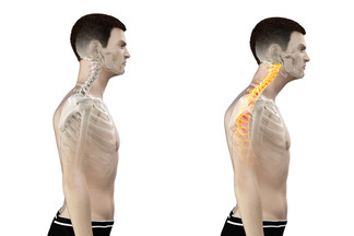 Addressing Forward Head Posture