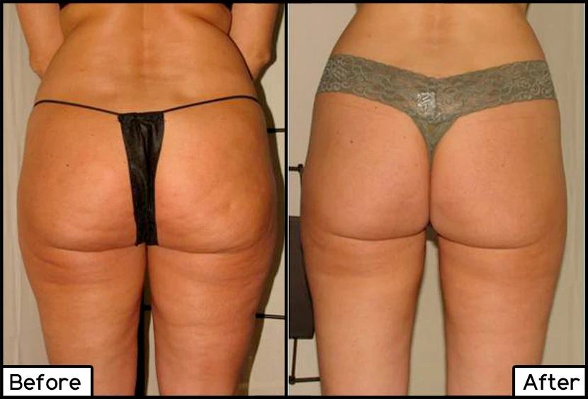 ThermiShape