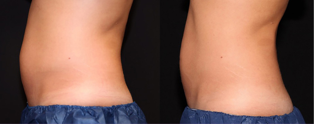 TruSculpt Glide