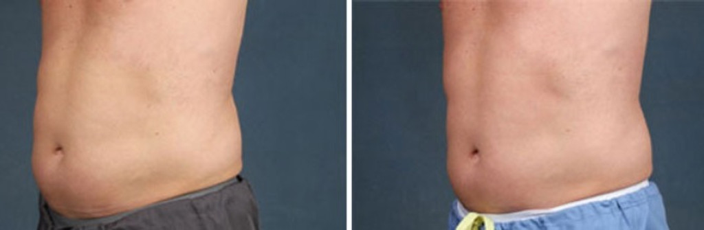 TruSculpt Glide
