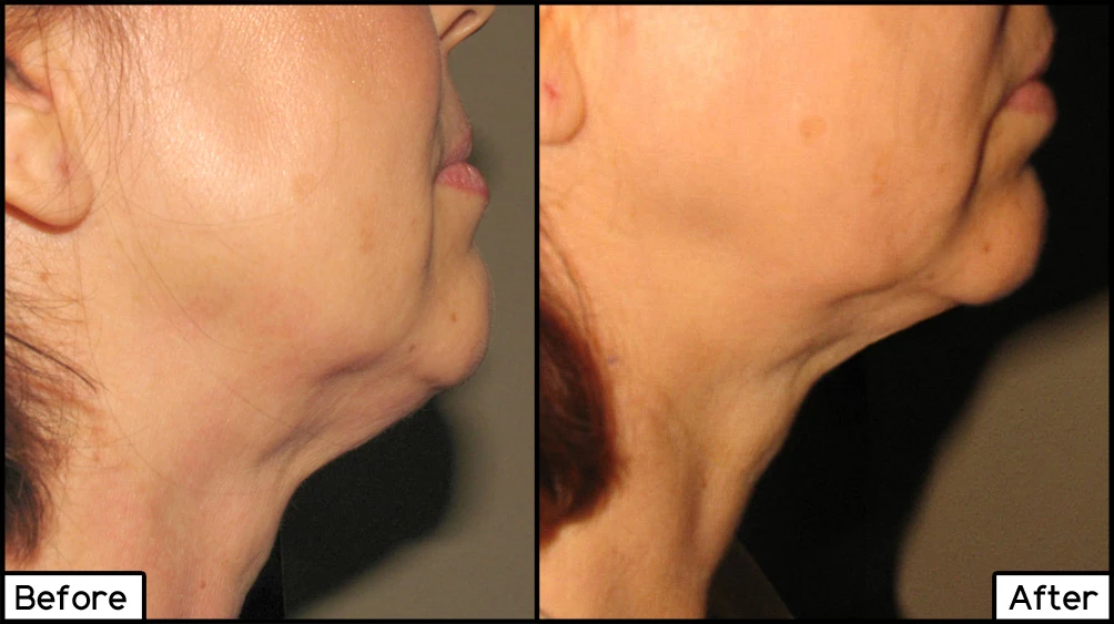 TruSculpt Contour
