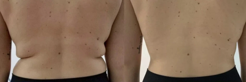 TruSculpt Contour