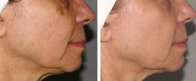 PhotoFacials IPL