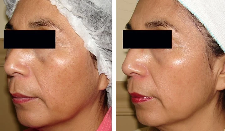 PhotoFacials IPL