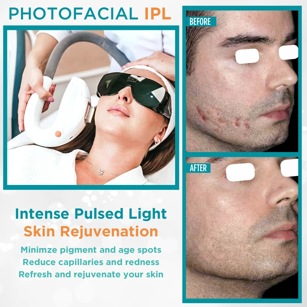 PhotoFacials IPL