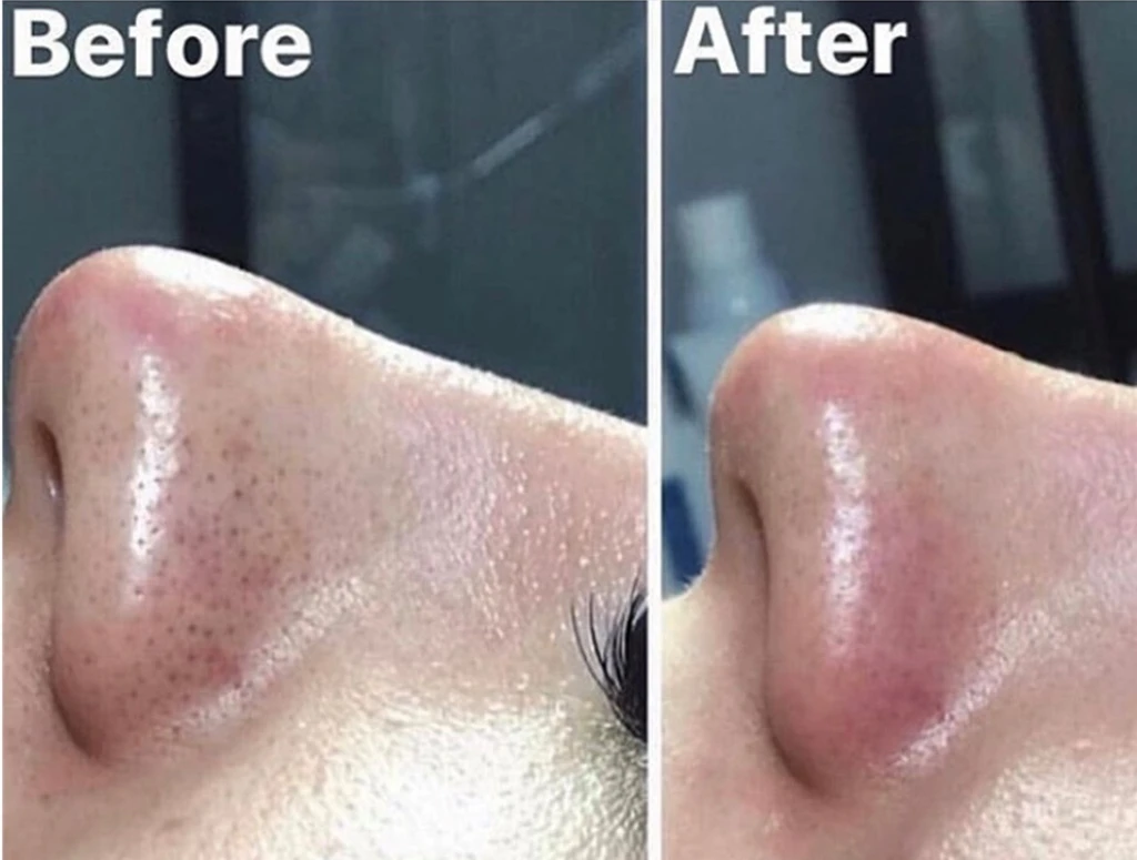 Dermal Infusion
