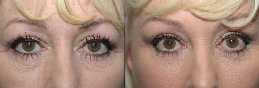 Facial Fillers