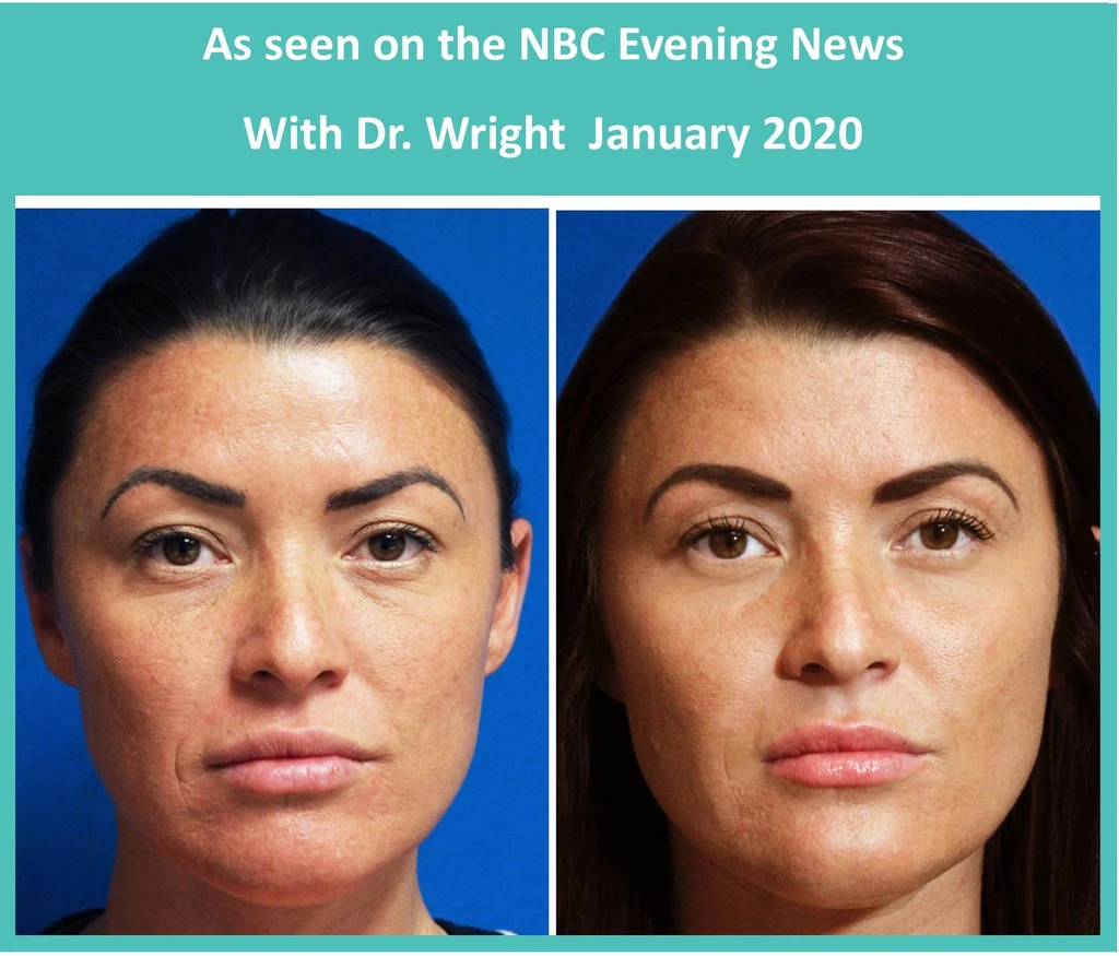 Facial Fillers