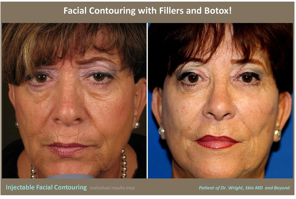 Facial Fillers