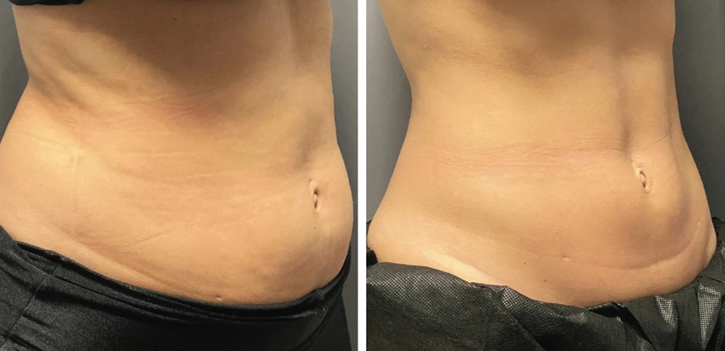 TruSculpt iD
