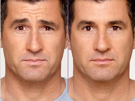 Botox