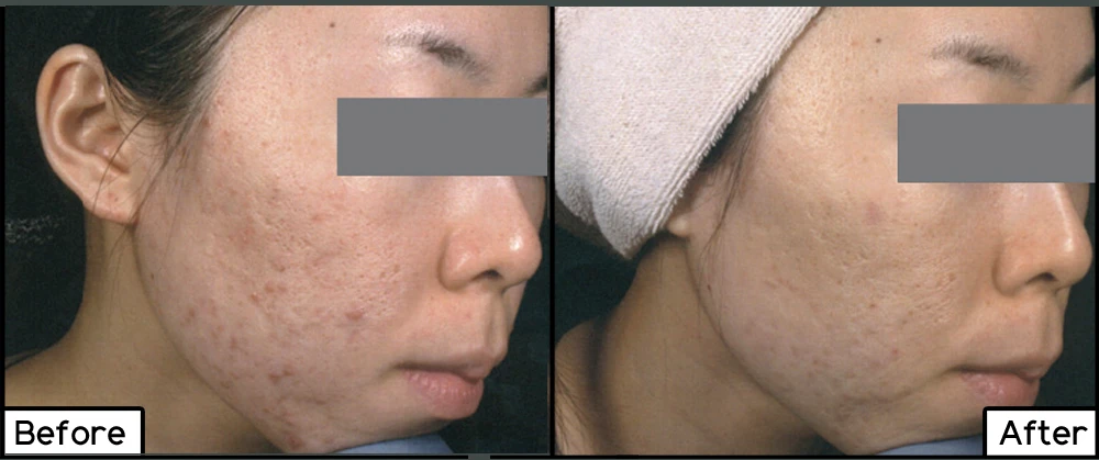 Dermapen