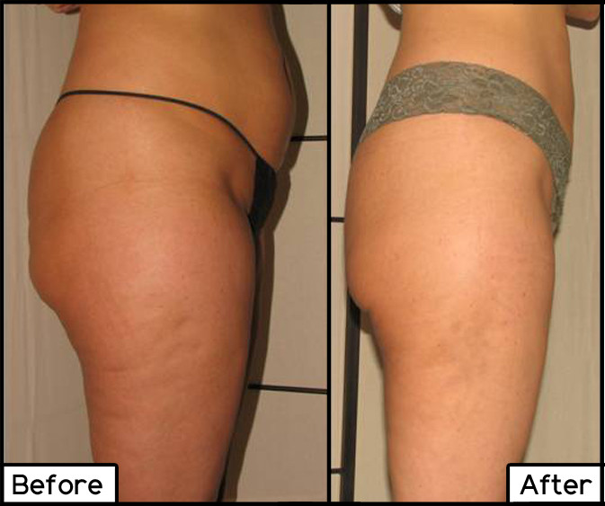 ThermiShape