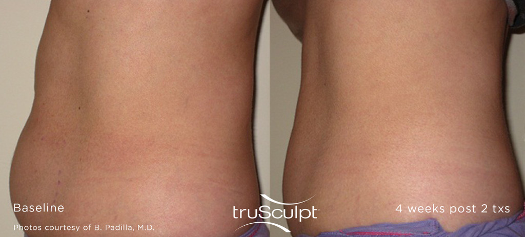TruSculpt Glide