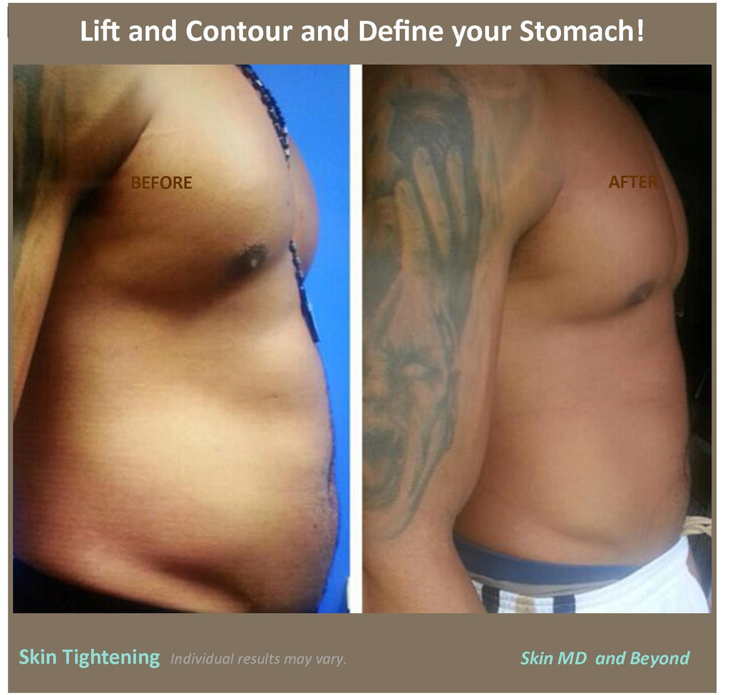 TruSculpt iD