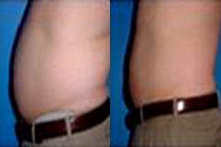 TruSculpt iD