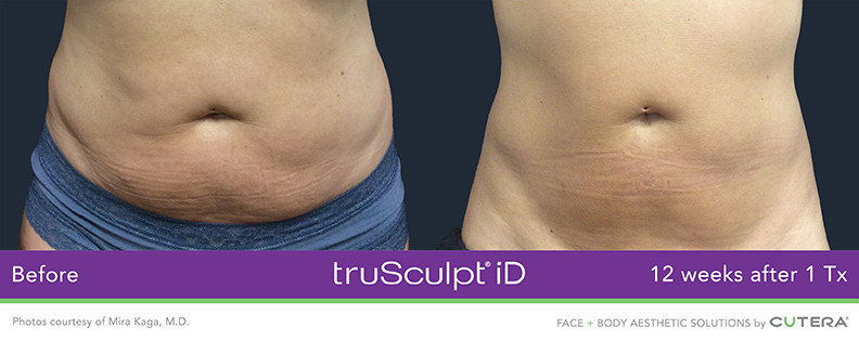 TruSculpt iD