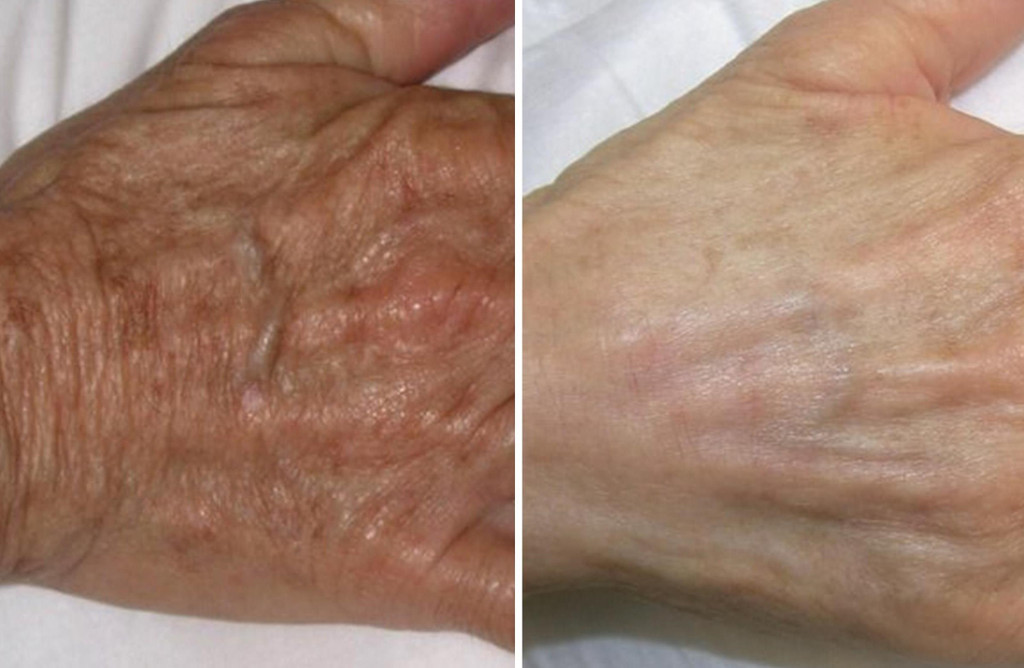 CO2 Laser Hand Resurfacing