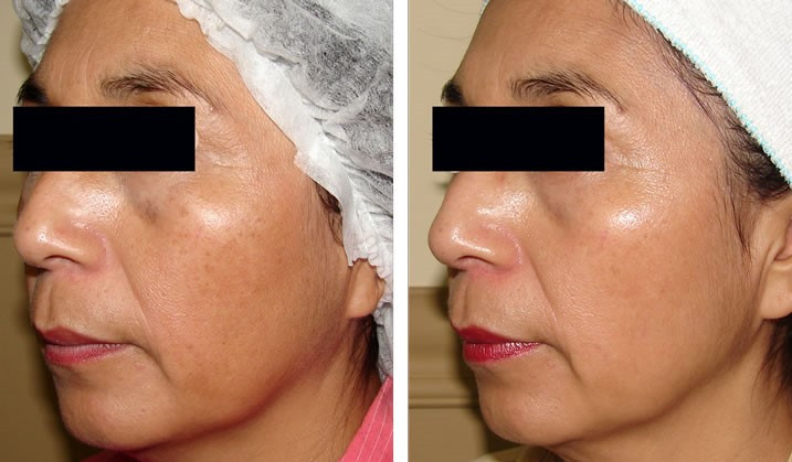 PhotoFacials IPL