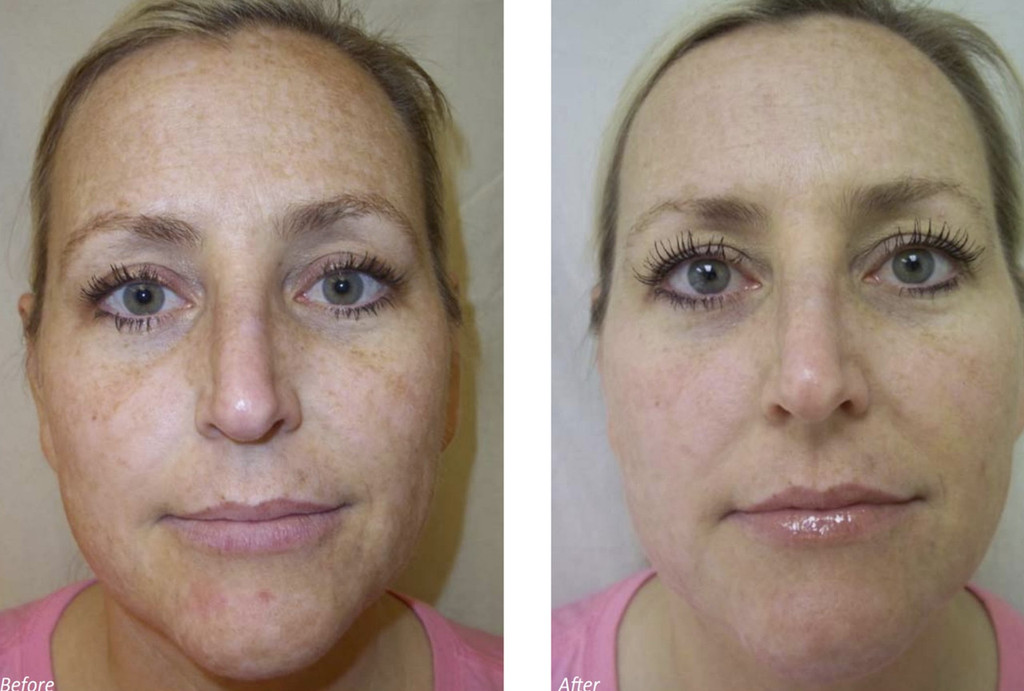 DermaFrac Micro-Needling