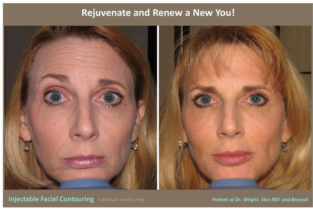 Facial Fillers