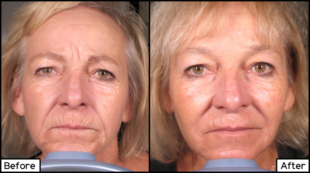 Facial Fillers