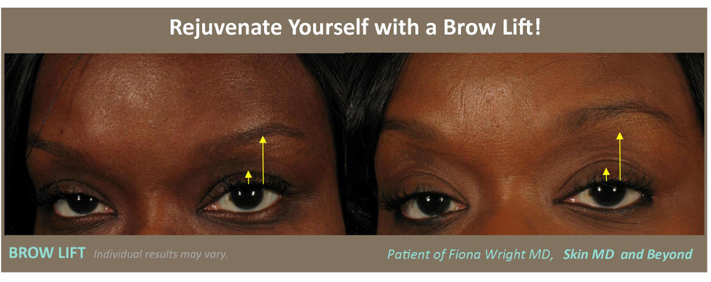 Botox