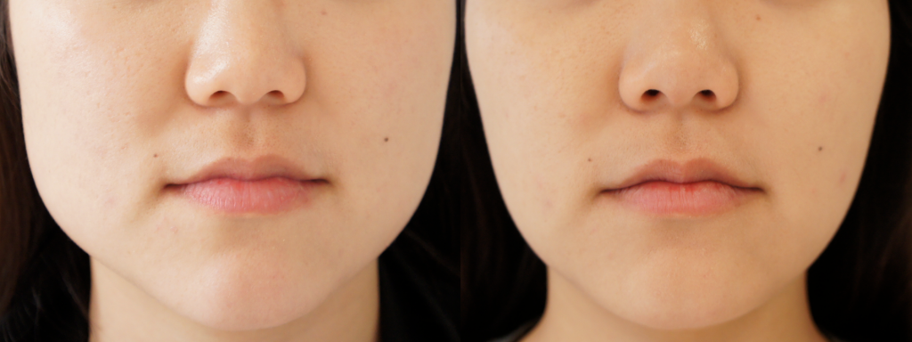 Botox