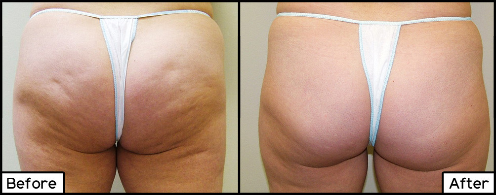 Cellulite Treatments