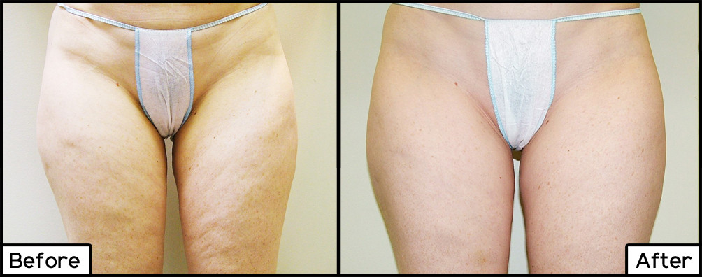 Cellulite Treatments