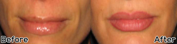 Juvederm Facial Fillers
