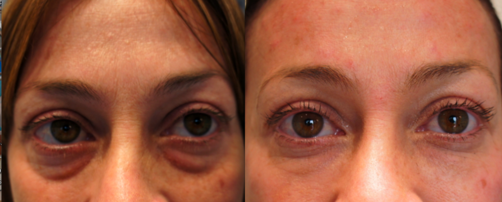 Juvederm Facial Fillers
