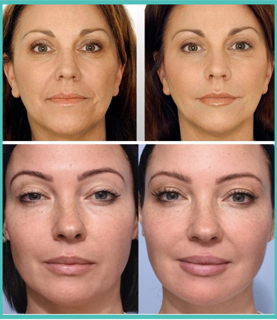 Juvederm Facial Fillers