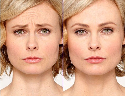 Botox