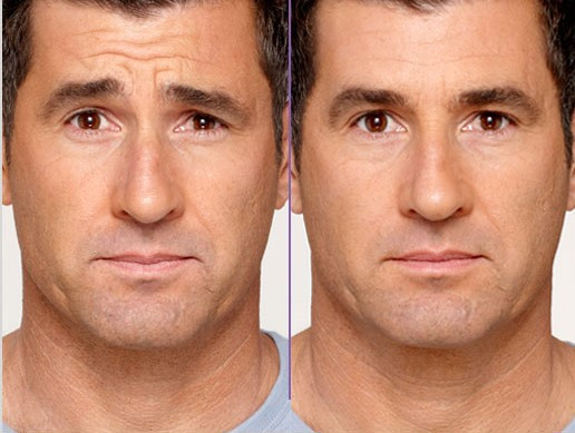 Botox