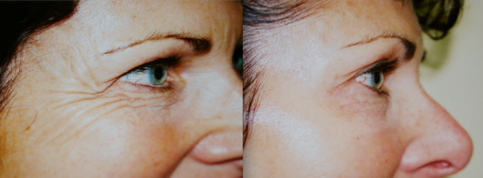 Botox
