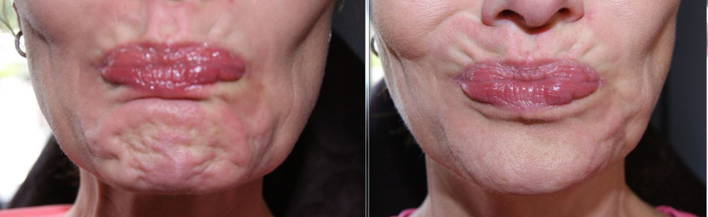 Botox