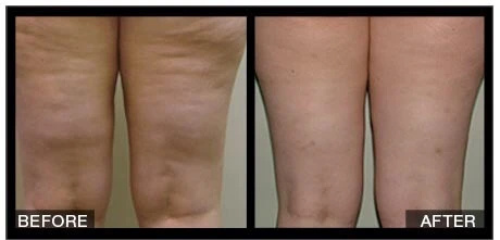 Cellulite Treatments