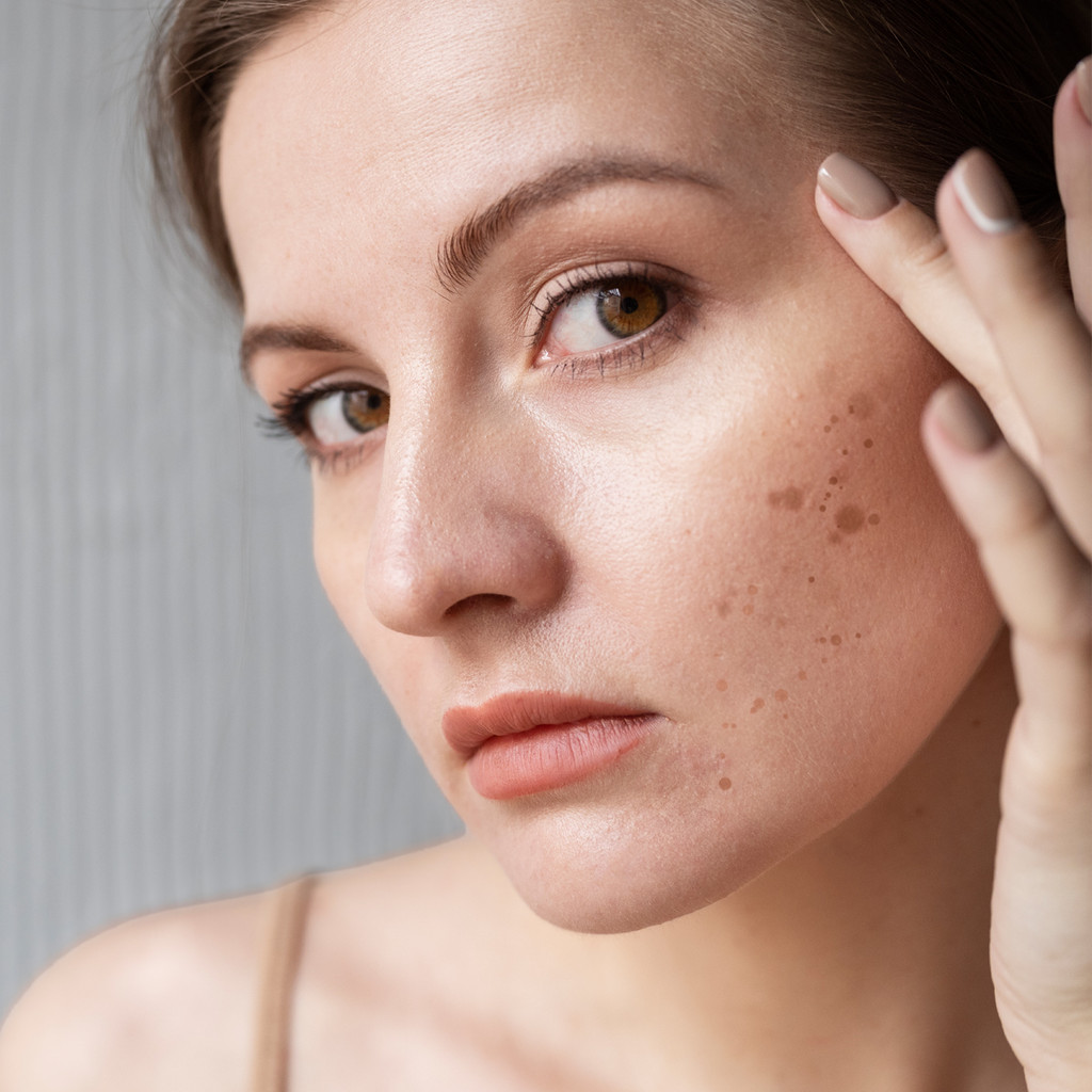 Do You Have Unwanted Skin Pigmentation? Try Our Radiance!