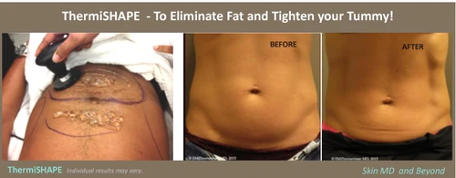 ThermiShape