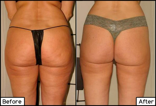 ThermiShape