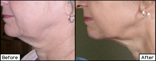 ThermiShape