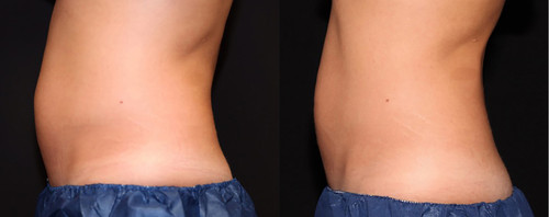 TruSculpt Glide