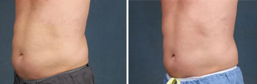 TruSculpt Glide