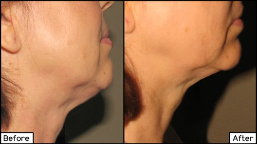 TruSculpt Contour
