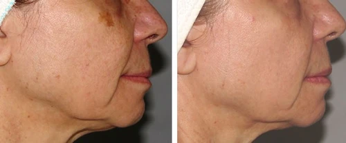 PhotoFacials IPL