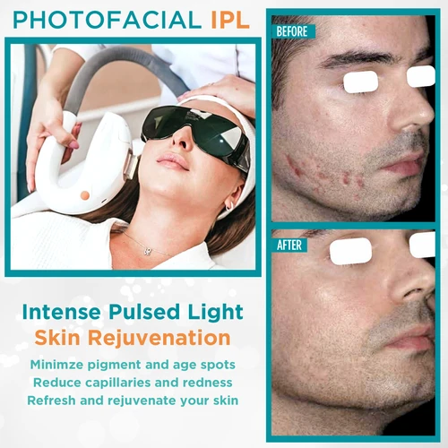 PhotoFacials IPL