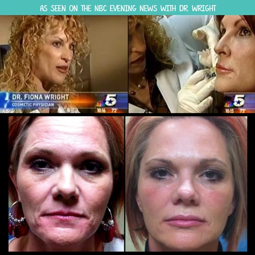 Facial Fillers