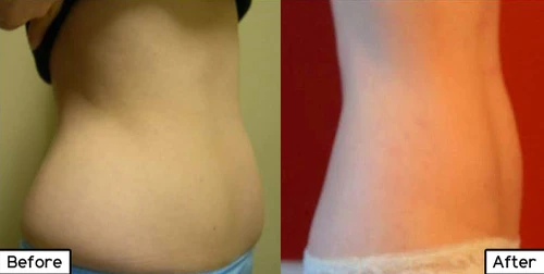 TruSculpt iD